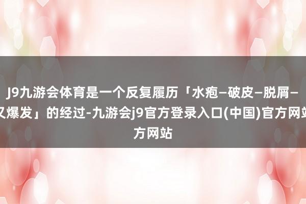 J9九游会体育是一个反复履历「水疱—破皮—脱屑—又爆发」的经过-九游会j9官方登录入口(中国)官方网站